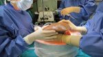 Trasplante-de-hígado-record-historico-trasplantes-donantes-españa-2023