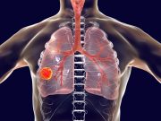 Cemiplimab-cancer-pulmon