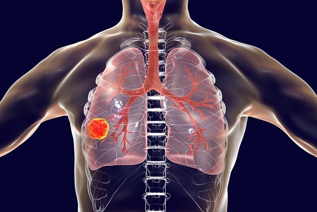 Cemiplimab-cancer-pulmon