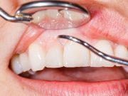 enfermedad-periodontal-fibrina