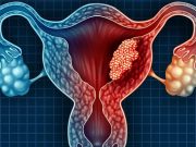 causa-genética-endometriosis