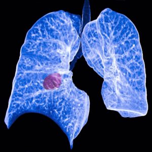 cáncer-de-pulmón-inmunoterapia
