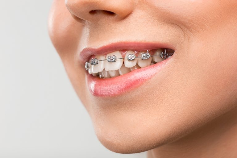 ortodoncia-preventiva- sonrisa-niños