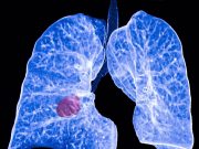 biomarcadores-cáncer-de-pulmón