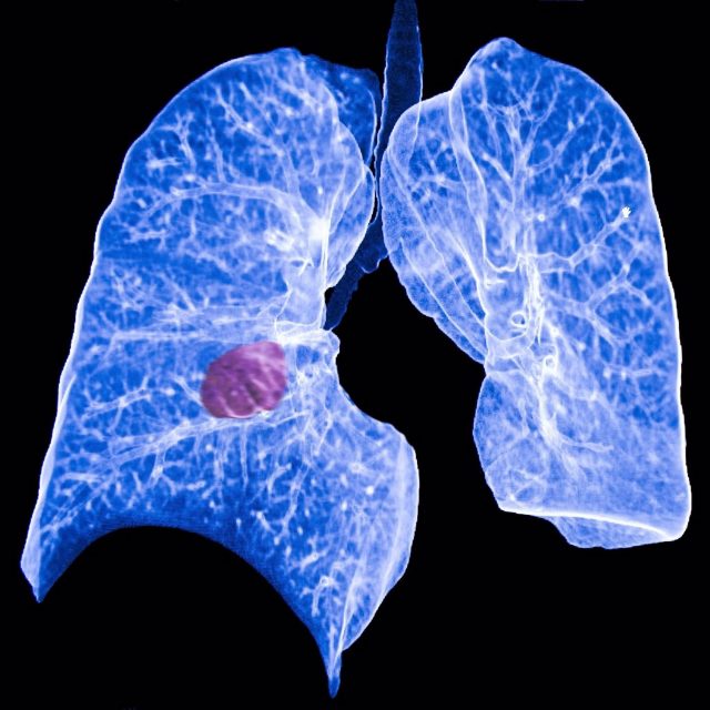 biomarcadores-cáncer-de-pulmón