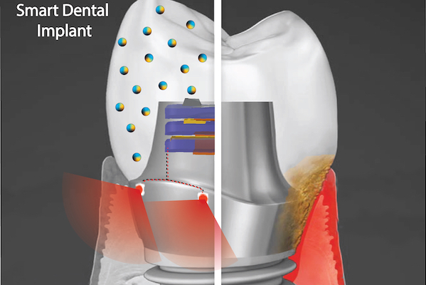 implante-dental-inteligente