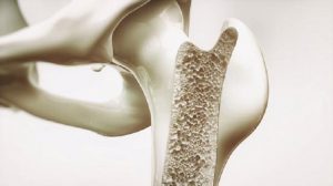 fractura-osteoporosis