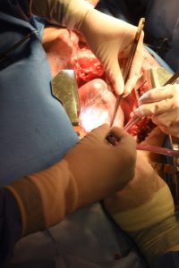 trasplante en un humano del corazón de un cerdo modificado genéticamente