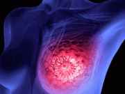cáncer-de-mama-triple-metastásico