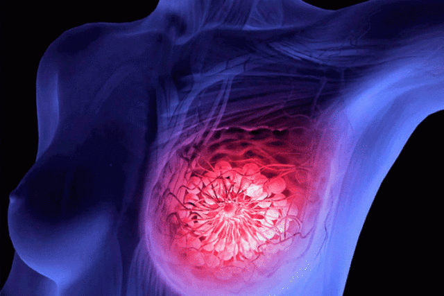 cáncer-de-mama-trastuzumab-deruxecan
