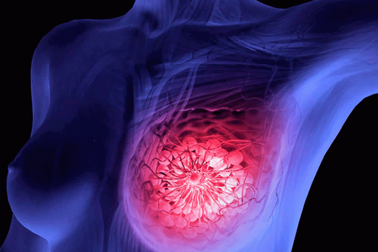 abemaciclib-cáncer- mama-metastásico