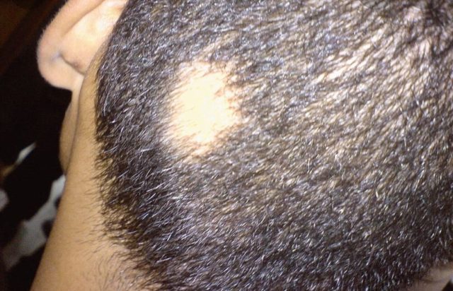baricitinib-alopecia-areata-grave