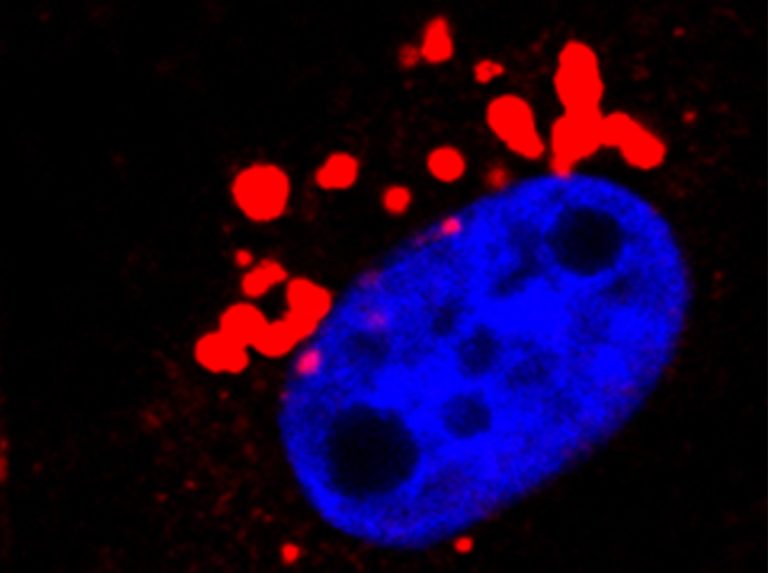 celula tumoral de cáncer de mama triple negativo tras el tratamiento con un ADC específico para una proteína expresada en la superficie de la célula tumoral