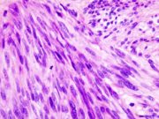 imagen-histopatologica-tumor-estroma-gastrointestinal-estudio-biopsia-liquida