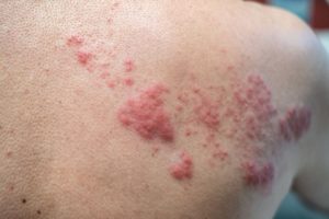 vacuna-herpes-zóster-lupus