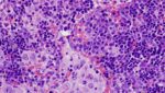 bazo-linfoma-ratones-mutacion-genetica-vav1-cancer-pulmón