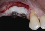microcirugía-reconstrucción-gingival-periodontal