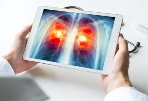 cnacer-pulmón-no-microcitico-metastasico