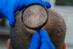 Alopecia-areata