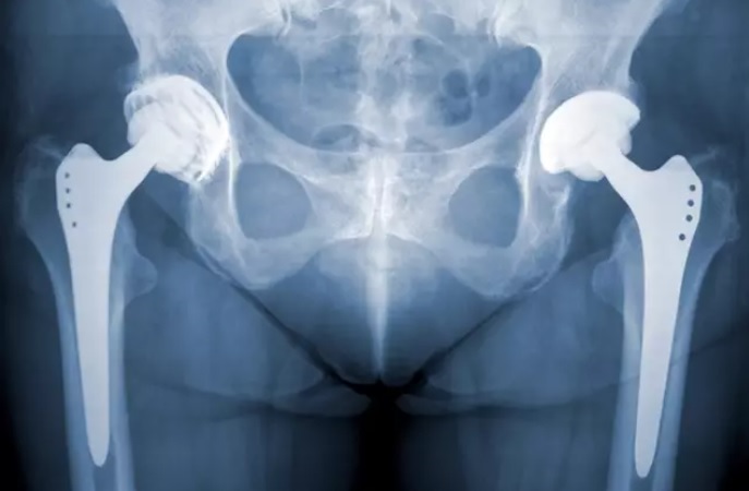 femoroplastias-prótesis- cadera
