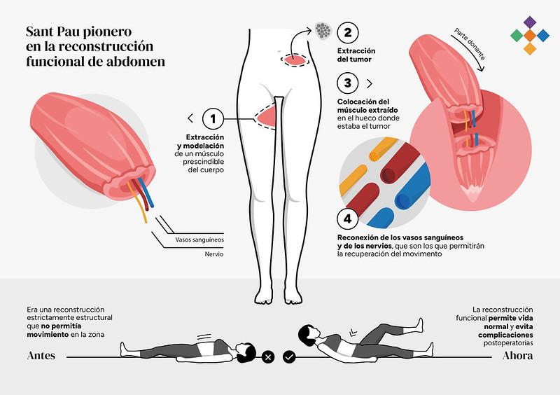 reconstruccion-abdominal-completa-infografia