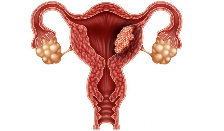 dostarlimab-cancer-endometrio-Pembrolizumab-lenvatinib