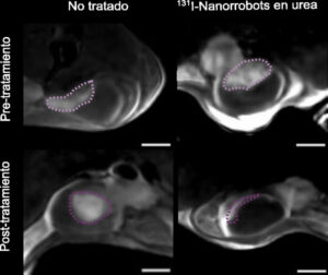 tumor reduction after treatment with nanorobot drugs