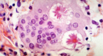 sarcoidosis-inmunodeficiencias