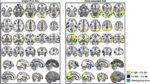 flujo-sanguineo-cerebral-alzheimer