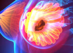 cancer-mama- trastuzumab deruxtecán-datopotamab-deruxtecan