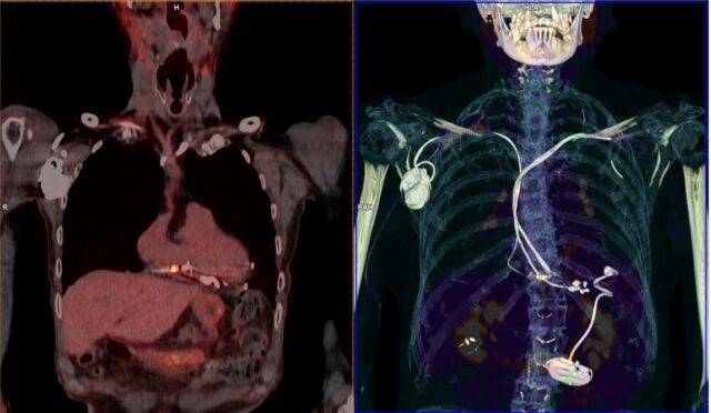 Advances in PET-CT are improving accuracy in heart disease