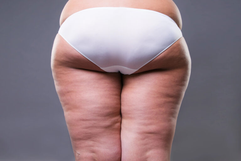 lipedema