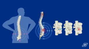 espondiloartritis