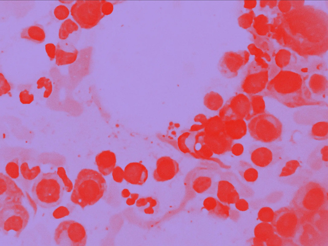 Darzalex-daratumumab-mieloma-multiple-Johnson-Johnson-J&J