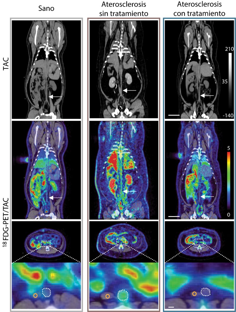 aterosclerosis