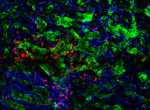 Metástasis cerebral