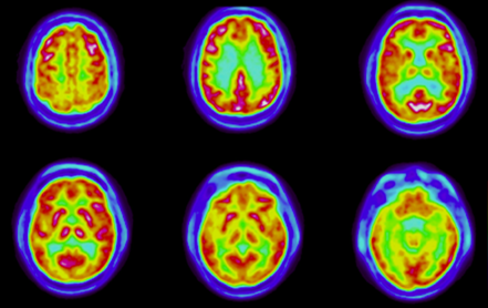 imagen-cerebro-neuroimagen-funcional-parkinson-medicina-nuclear
