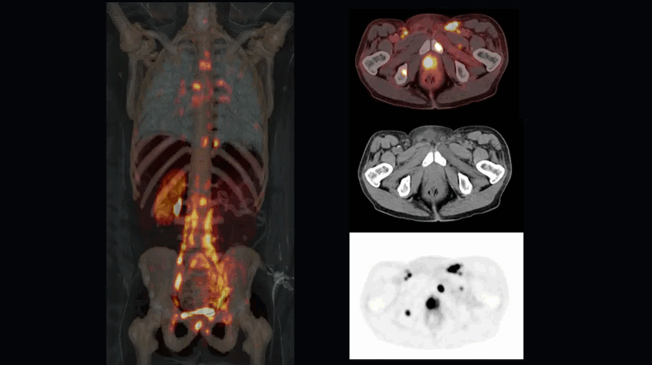 imagen-molecular-teragnosis-cáncer