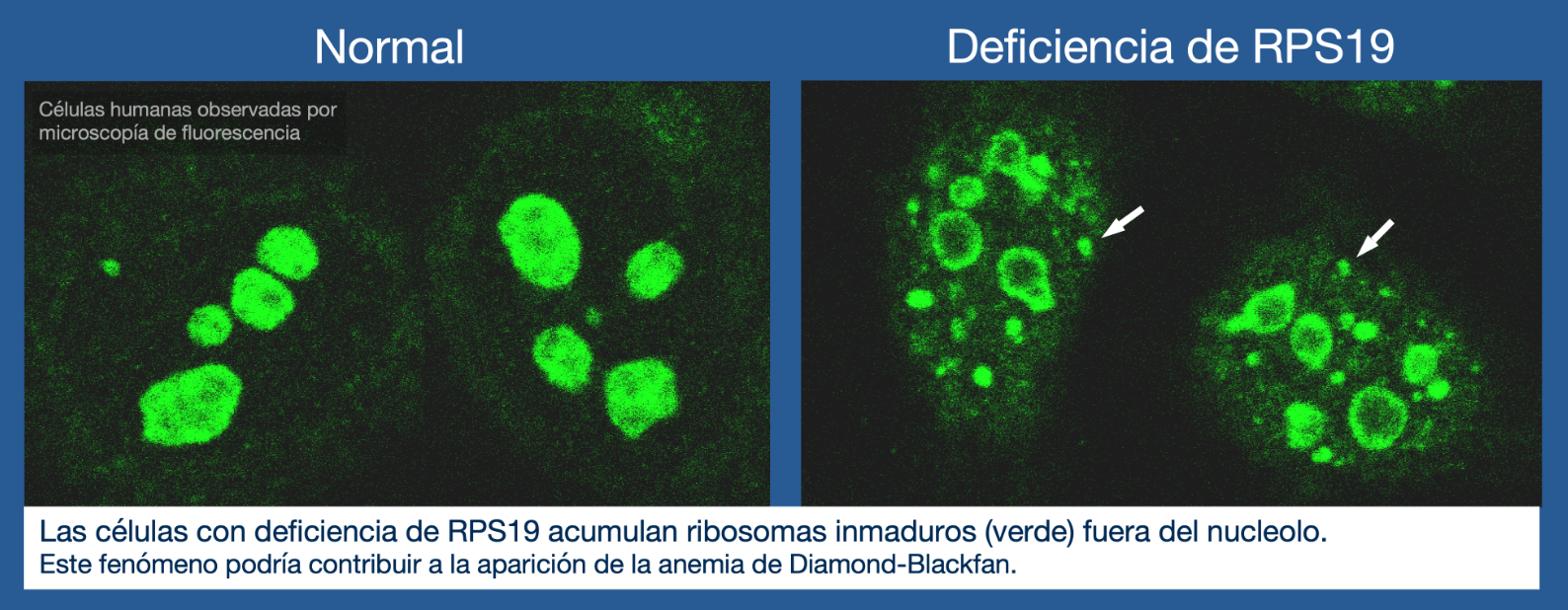 ribosomas-enfermedades-raras-sangre