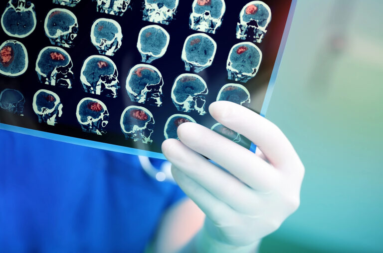 Tumores cerebrales